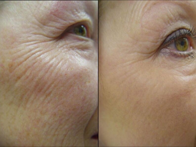 Before and after laser rejuvenation procedure - significant reduction of wrinkles