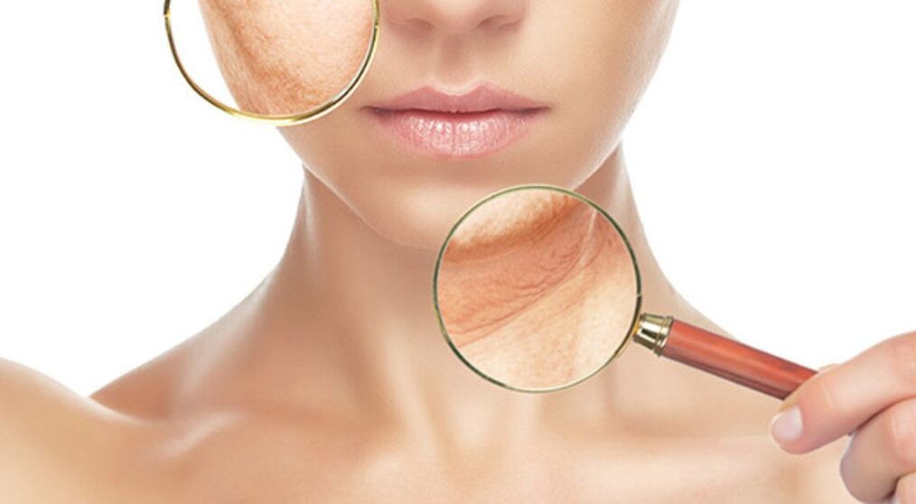 Wrinkles can be effectively eliminated with laser therapy