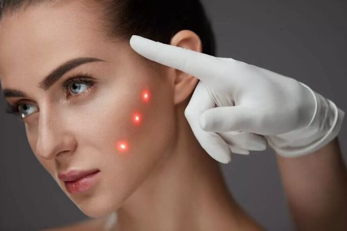 Laser the renewal of the skin