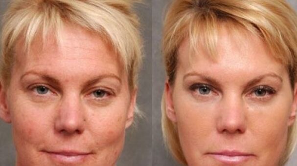 Before and after the renewal action