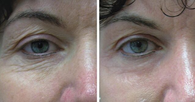 Skin solves around the eyes